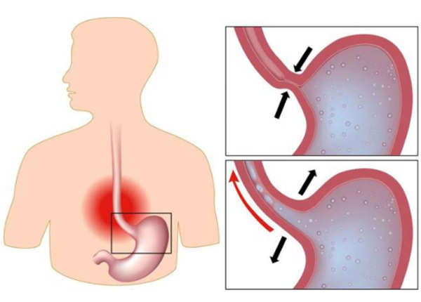 CO THẮT THỰC QUẢN – NHỮNG DẤU HIỆU CẢNH BÁO CHẾT NGƯỜI